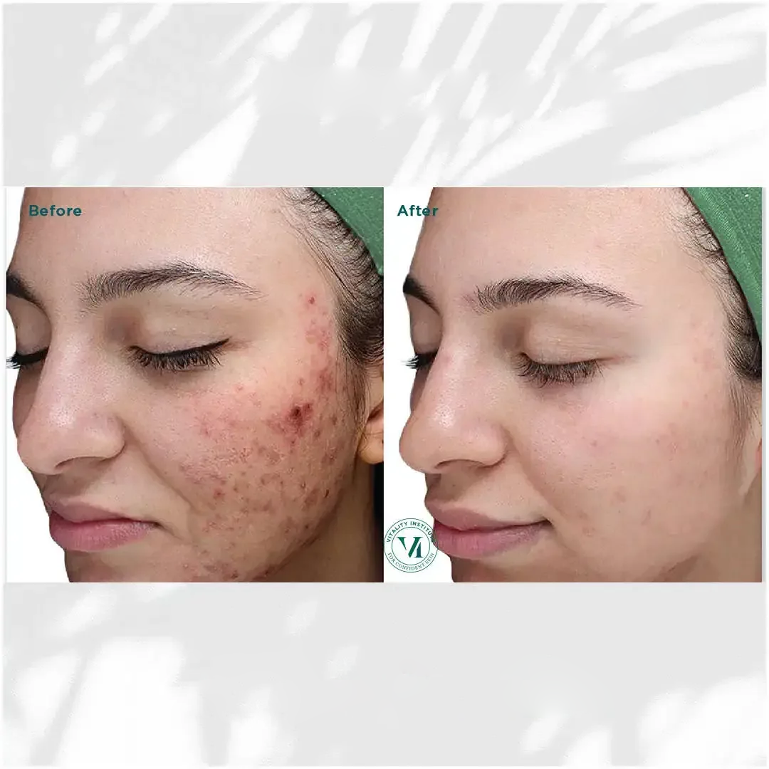 hausofwell_services_chemical-peel-with-vi-peel-B&A