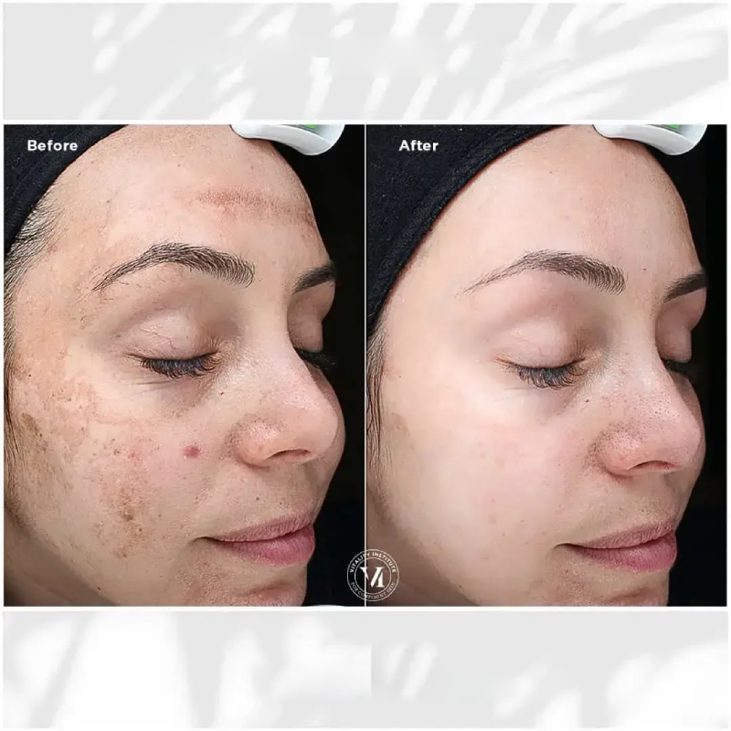 hausofwell_services_chemical-peel-with-vi-peel-Before-After (2)