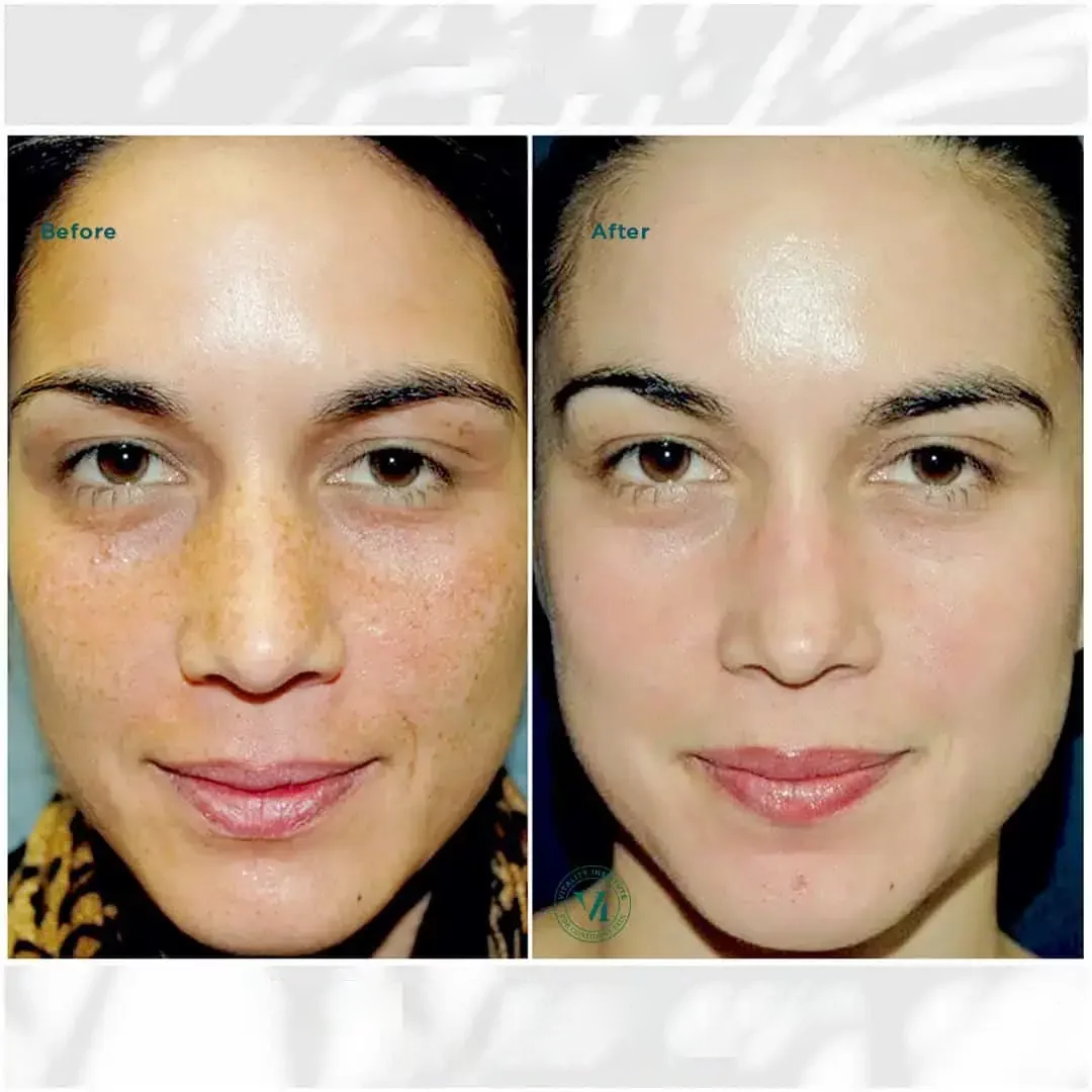 hausofwell_services_chemical-peel-with-vi-peel-Before-After