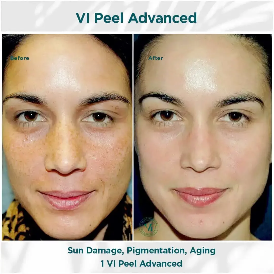 hausofwell_services_chemical-peel-with-vi-peel_B&F 1