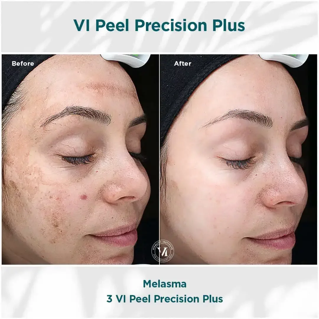 hausofwell_services_chemical-peel-with-vi-peel_B&F 2