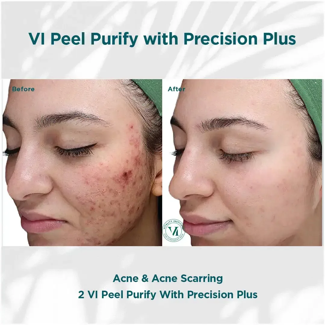 hausofwell_services_chemical-peel-with-vi-peel_B&F 3